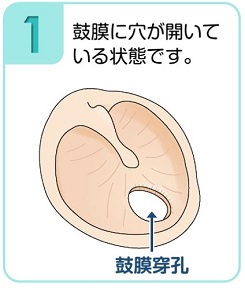 鼓膜に穴が開いている。