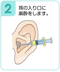 耳の入り口に麻酔をします。