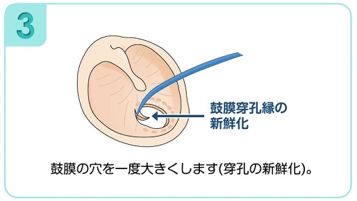 鼓膜の穴を一度大きくします（穿孔の新鮮化）。