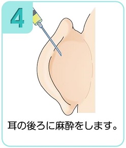 耳の後ろに麻酔をします。