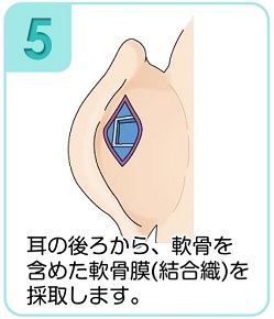 耳の後ろから、軟骨を含めた軟骨膜（結合織）を採取します。
