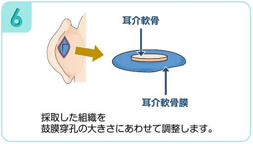 採取した組織を鼓膜穿孔の大きさにあわせて調整します。