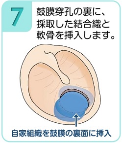 鼓膜穿孔の裏に、採取した結合織と軟骨を挿入します。