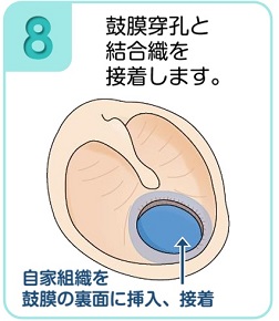 鼓膜穿孔と結合織を接着します。
