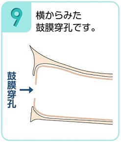 横からみた鼓膜穿孔。