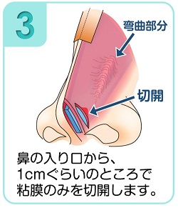 粘膜のみを切開