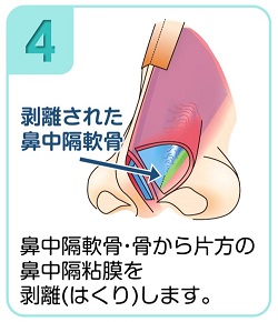 鼻中隔軟骨・骨から片方の鼻中隔粘膜を剥離