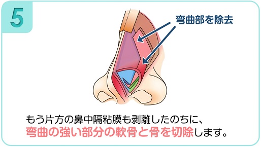 弯曲の強い部分を切除