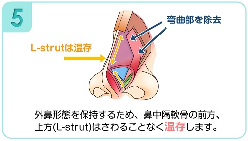 弯曲の強い部分を切除