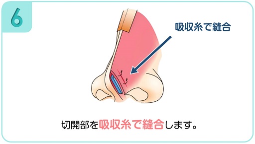 吸収糸で縫合