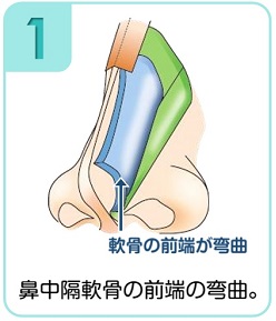 鼻中隔軟骨の前端の弯曲