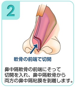 鼻中隔軟骨から両方の鼻中隔粘膜を剥離