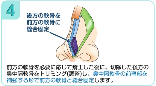 前方の軟骨と縫合固定