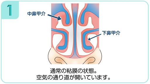 下鼻甲介手術（粘膜下下鼻甲介骨切除術・下鼻甲介粘膜切除術）1