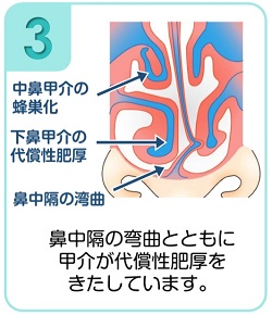 下鼻甲介手術（粘膜下下鼻甲介骨切除術・下鼻甲介粘膜切除術）3