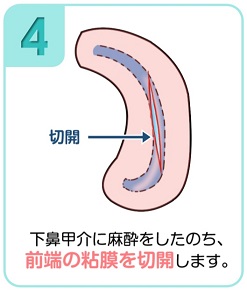 下鼻甲介手術（粘膜下下鼻甲介骨切除術・下鼻甲介粘膜切除術）4