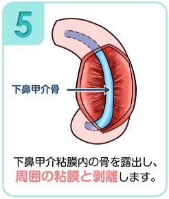 下鼻甲介手術（粘膜下下鼻甲介骨切除術・下鼻甲介粘膜切除術）5