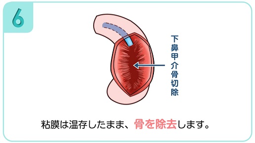 下鼻甲介手術（粘膜下下鼻甲介骨切除術・下鼻甲介粘膜切除術）6