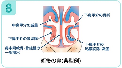 下鼻甲介手術（粘膜下下鼻甲介骨切除術・下鼻甲介粘膜切除術）8