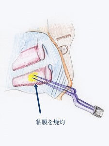 下甲介粘膜焼灼術　手術方法3