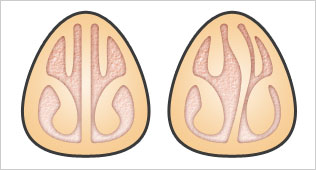 副鼻腔炎（蓄膿症）の原因の一つは鼻中隔弯曲症