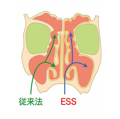 内視鏡下副鼻腔手術（ESS）