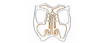 病変とポリープが取り除かれると各副鼻腔が鼻腔へと解放します。