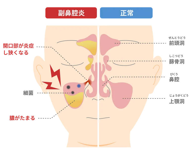 副鼻腔炎（慢性・急性）