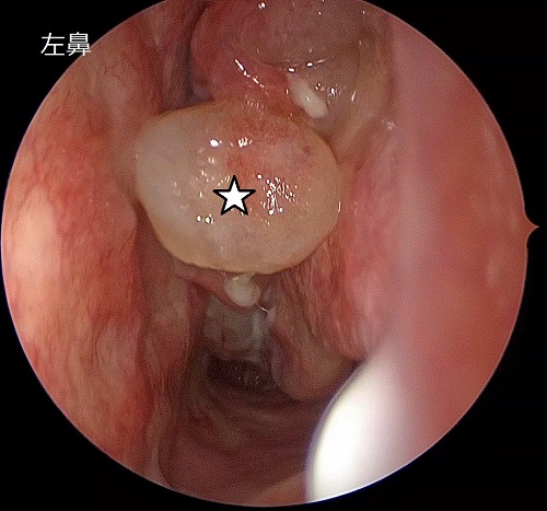 難病指定の好酸球性副鼻腔炎