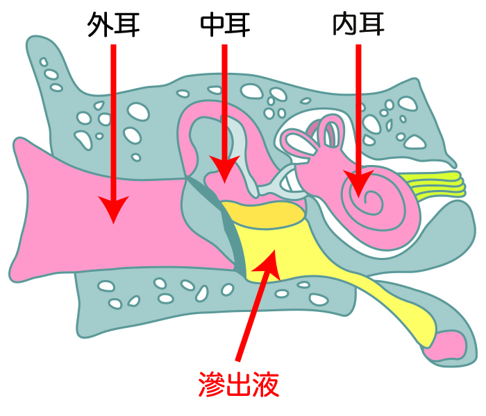 滲出性中耳炎は症状に気づきにくい