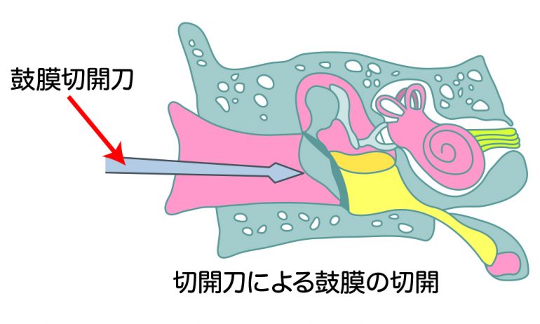 鼓膜切開術