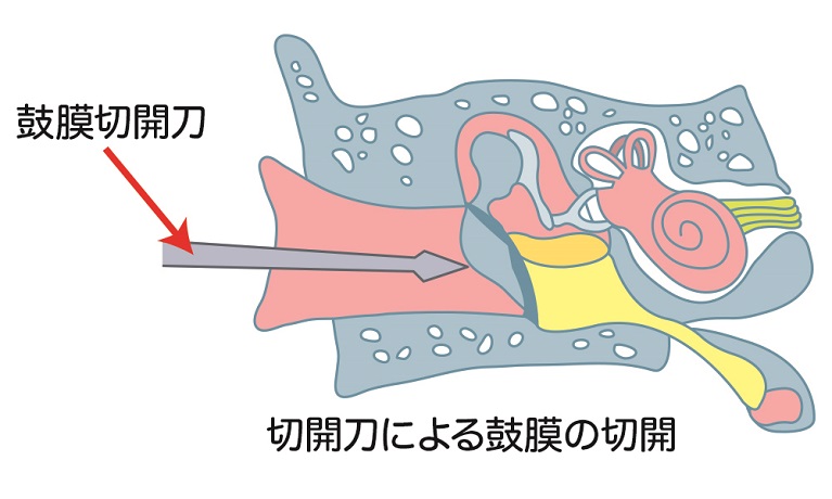 重度の急性中耳炎の治療法